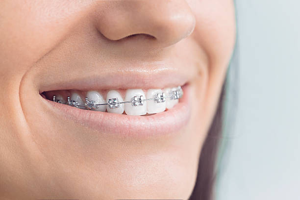 Best Invisalign and Clear Aligners  in USA